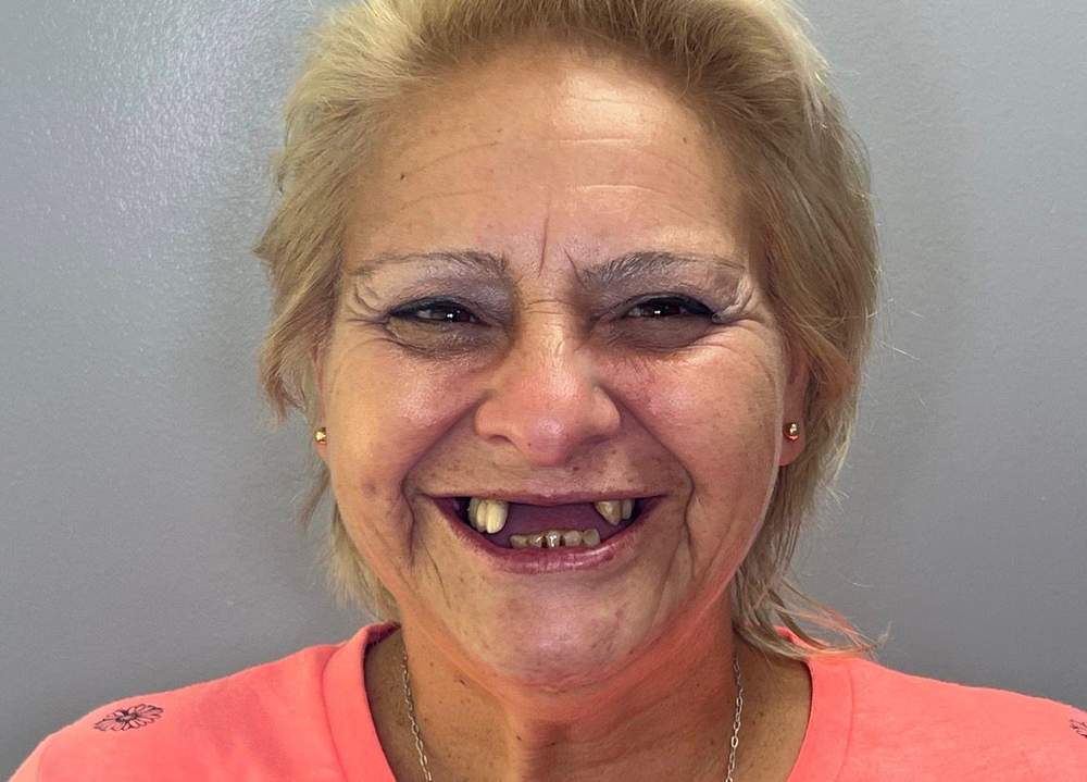 Johana antes del procedimiento